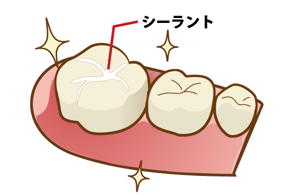 シーラント