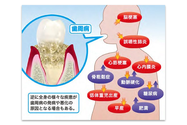 歯周病は全身疾患の図