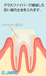 ファイバーコア 手順2