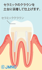 ファイバーコア 手順3