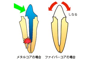 歯根破折の比較